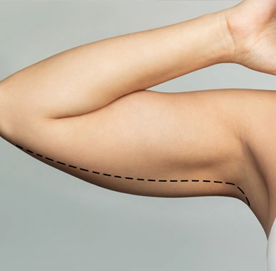 Upper Arm Fat Reduction