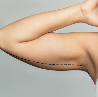 Upper Arm Fat Reduction