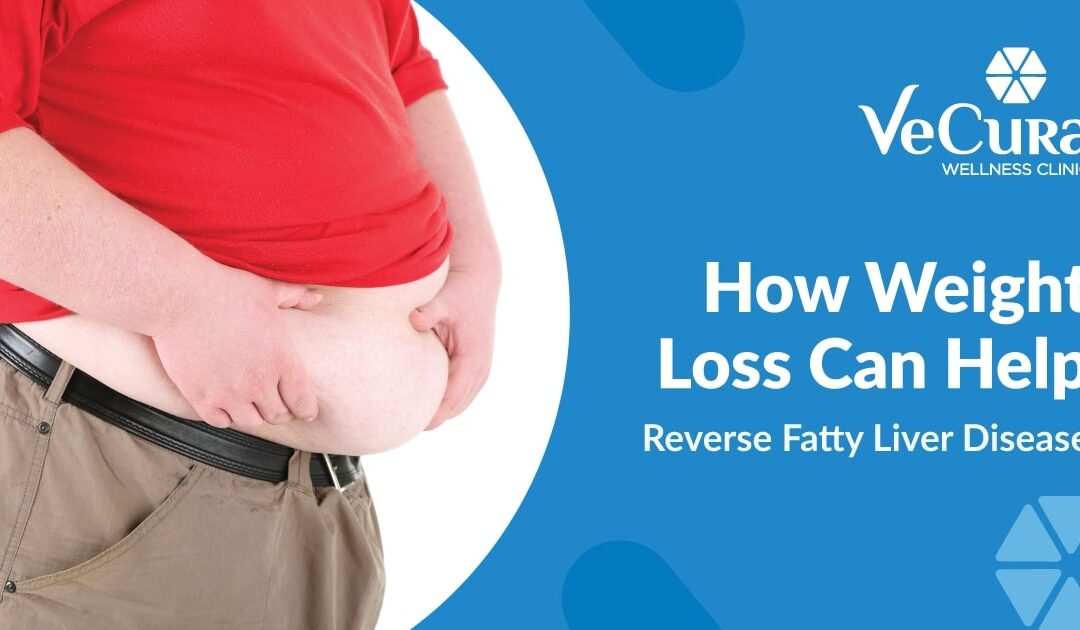 How Weight Loss Can Help Reverse Fatty Liver Disease